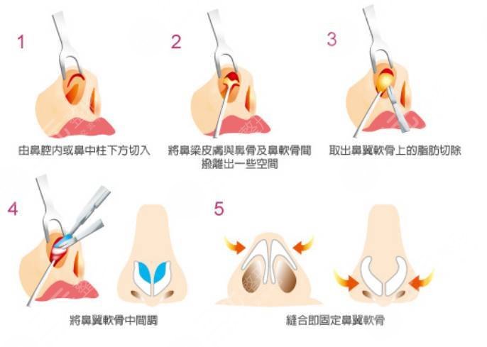 韩式鼻尖整形方法有哪些